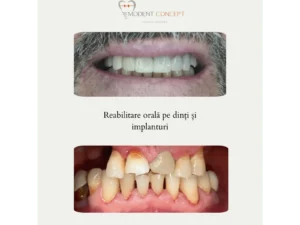 lucrarepedinti si implanturi